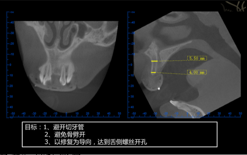 切牙管在哪图图片